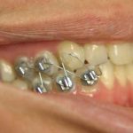 الخبراء يحذرون من تربيط الأسنان للتنحيف