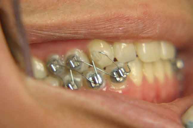 الخبراء يحذرون من تربيط الأسنان للتنحيف